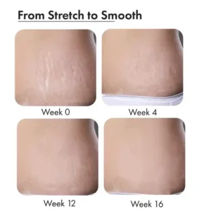 Stretch Mark Creams
